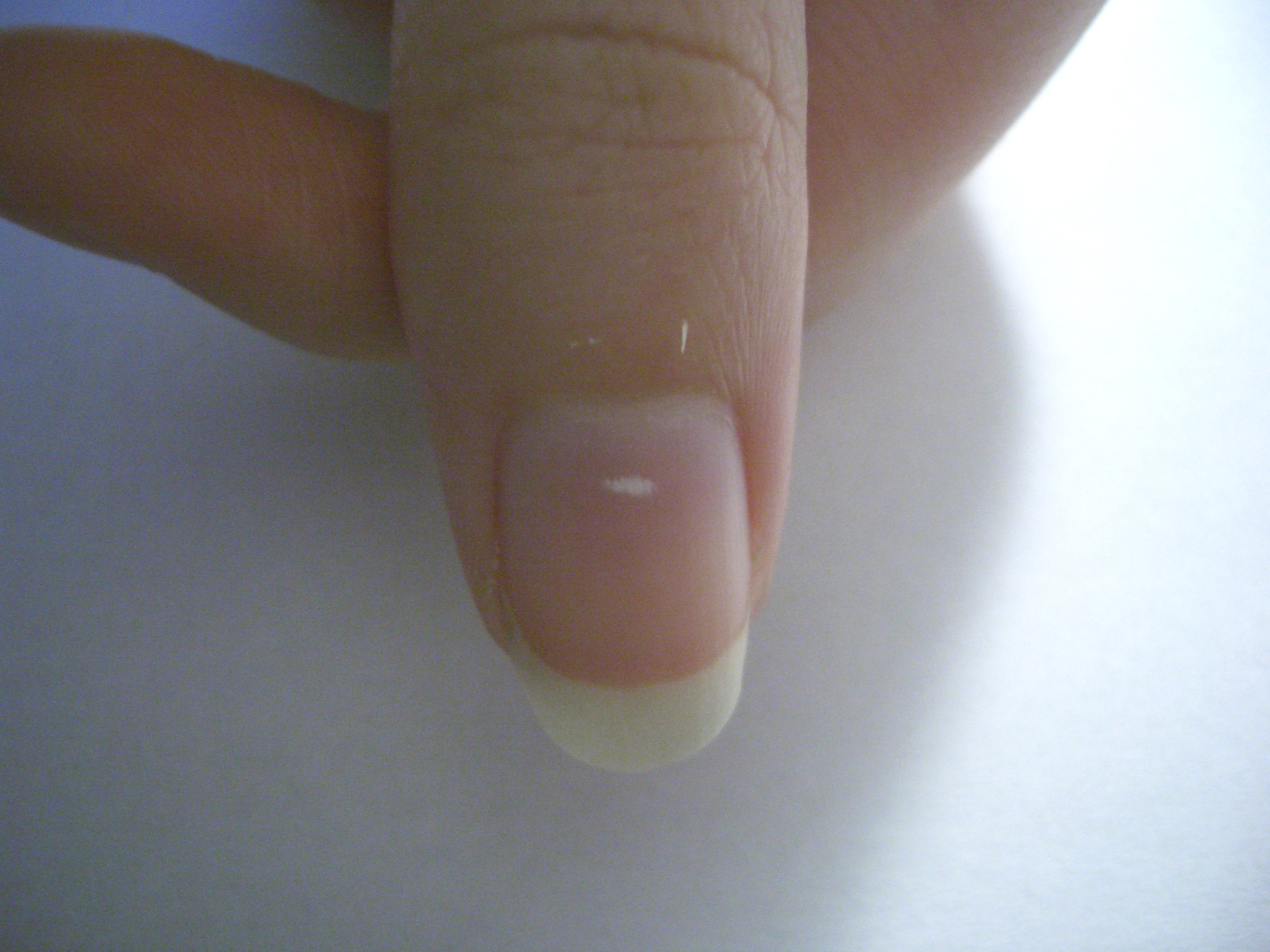 Почему ноготь маленький. Лейконихия белые пятна на ногтях. Лейконихия (белые пятнышки). Белые полоски - лейконихия ногтей.