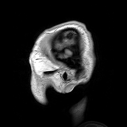 Parasagittal_MRI_of_human_head_in_patient_with_benign_familial_macrocephaly_prior_to_brain_injury_%28ANIMATED%29.gif